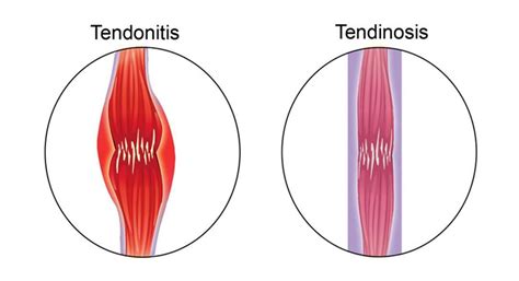 Tendinosis Versus Tendinitis Proactive Spine And Joint
