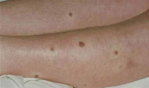 The Best 5 Skin Cancer Red Spots On Legs Jamnomesesz