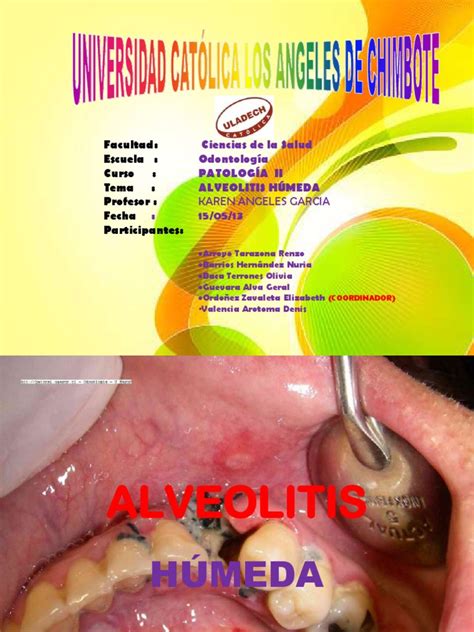 Alveolitis Humeda Expo