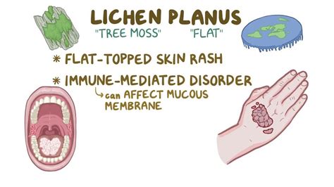 Lichen Simplex What Is It Causes Treatment And More Osmosis