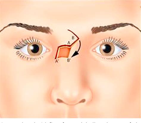 Figure 10 From Transposition Flaps In Nasal Reconstruction Semantic