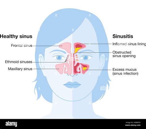 Vector Illustration Showing Healthy Sinus And Sinusitis With Inflamed