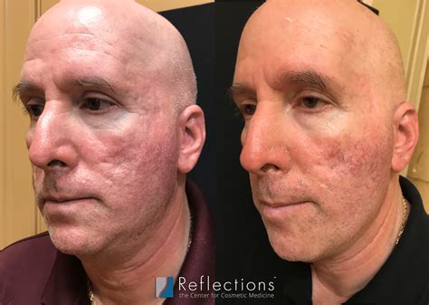 Acne Scars Treated With Rf Microneedling And Fillers Before And After
