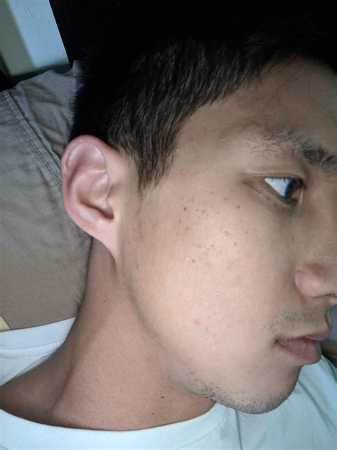 Help With Dark Spots Cystic Acne Cleared Up But Over Time These