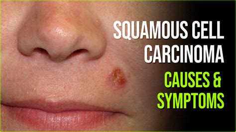 Squamous Cell Carcinoma Second Most Common Type Of Cancer