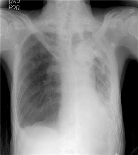 Plain Chest Radiography Demonstrates Right Apical Download Scientific