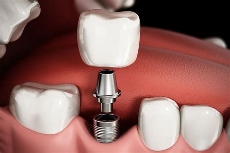 Graphic Of Dental Implant With Crown Champagne Smiles