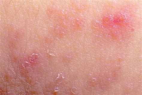 Atopic Dermatitis Flare Up Atopic Skin Eucerin
