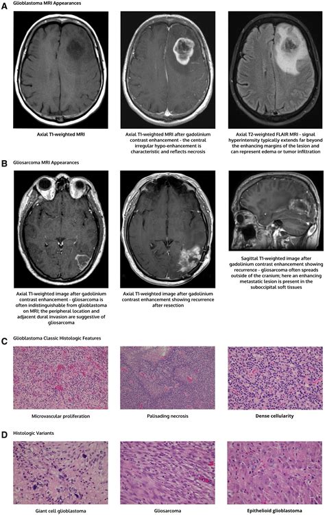 Management Of Glioblastoma State Of The Art And Future Directions