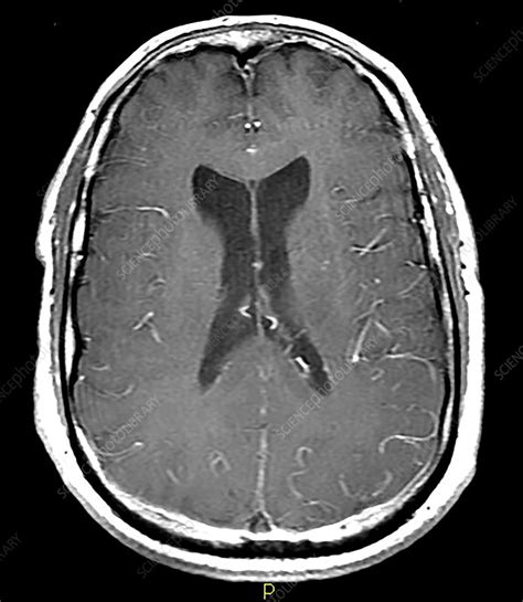 Extensive Dural Sinus Thrombosis Mri Stock Image C0365128