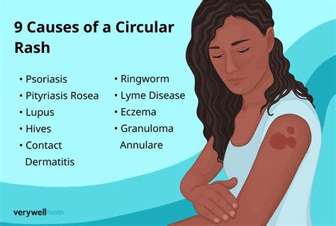 Circular Rash Common Causes That Arent Ringworm