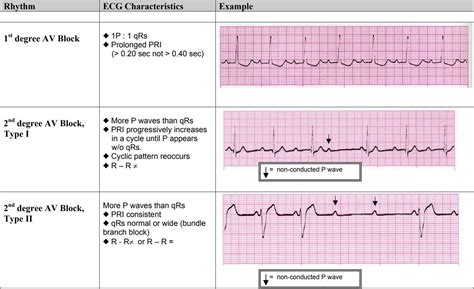 Ekg Examples Pdf Electrocardiography Cardiovascular System Artofit