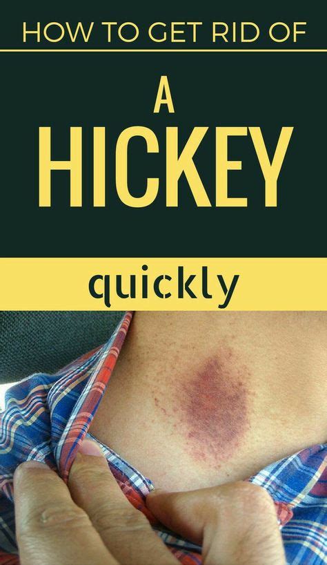 how to remove or hide a hickey love bite fast how to hide hickeys kiss mark get rid of hickies