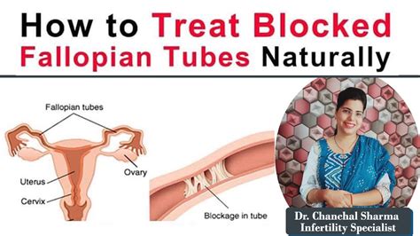 Natural Treatments For Blocked Fallopian Tubes In English Dr Chanchal