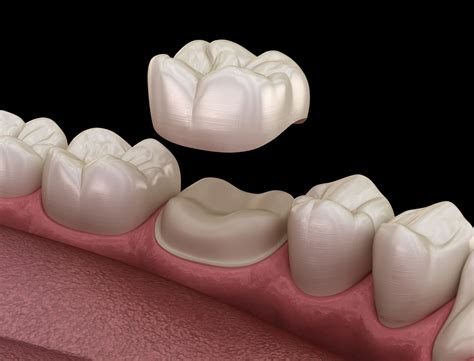 Dental Implant Vs Crown Which Is The Right Choice For You Hanna