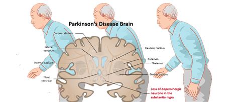 Parkinsons Disease Symptoms Causes Complications Remedies