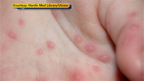 Hand Foot And Mouth Disease Outbreak At Princeton University 6abc Philadelphia