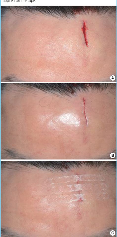 Figure 1 From The Usefulness Of Leukosan Skinlink For Simple Facial