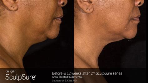 Sculpsure Before And After Photos Real Patient Results New Beauty