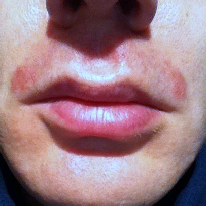 Dry Flaky Skin Above Lips Lipstutorial Org
