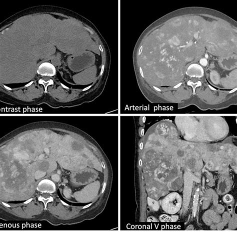Multiphase Ct Scan Of The Liver In Case 4 Illustrates Multiple