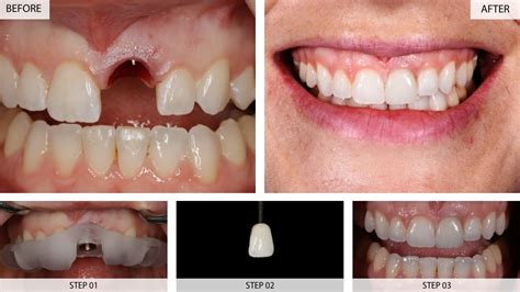 Dental Implants Results Before And After 22 Cases