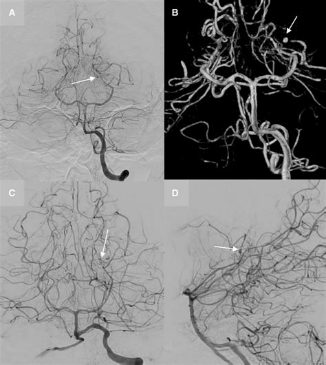 Cerebral Angiography On Day 0 And Day 6 A Dsa Of The Left Vertebral
