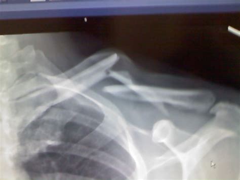 Re Fractured Clavicle