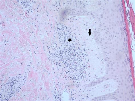 Perivascular And Interstitial Dermatitis With Neutrophils Small