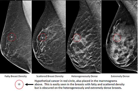 Molecular Breast Imaging Snmmi