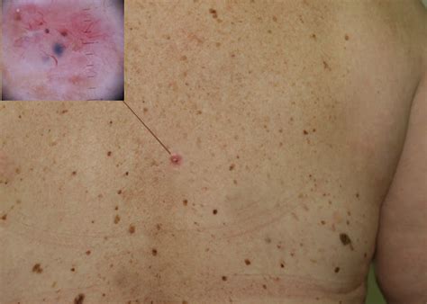 Skin Cancer Skin Cancer Early Stages