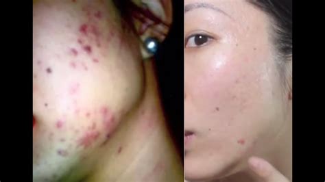 How To Get Rid Of Acne Acne Scarring Youtube