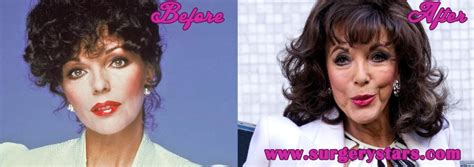Joan Collins Plastic Surgery Before After Pics