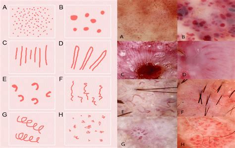 Schematic Representation Left And Dermatoscopic Image Of Examples