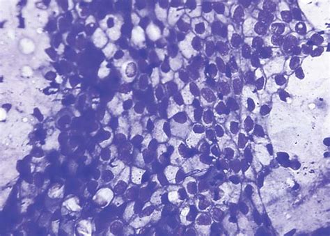 High Power Photomicrograph Of The Cytology Of Mucinous Adenocarcinoma