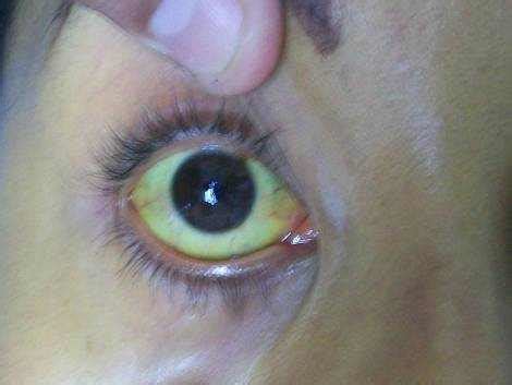 Another cause of yellowing of the eyes is yellow fever. What Does It Mean When Your Eyes Are Yellow?