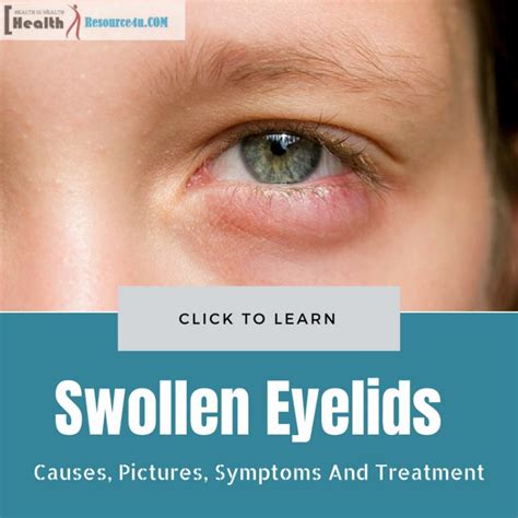 Upper Eyelid Swelling Causes