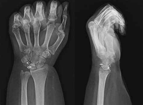 Avascular Necrosis Of The Lunate Following Reconstruction Of The