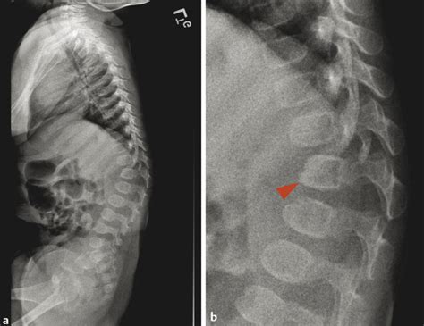 26 Congenitaldevelopmental Spine Abnormalities Radiology Key