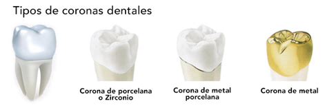 Coronas De Porcelana Ventajas Desventajas Y Fotos De Antes Y Despu S