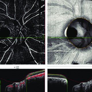 Optical Coherence Tomography Angiography Demonstrates Cavitation In The Download Scientific