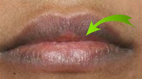 Miracle Home Remedies On How To Naturally Lighten Dark Lips Smokers