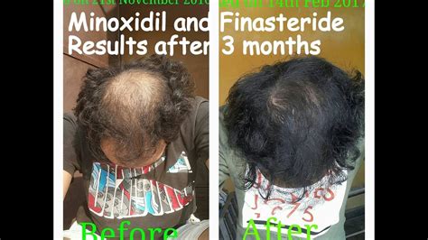 After this period, you will most likely encounter phases of shedding and stagnation, and then spikes in growth. Minoxidil and Finasteride Results after 3 Months Usage ...