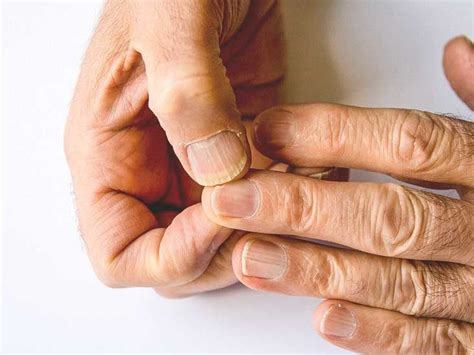Fingernail Test For Anemia Bios Pics