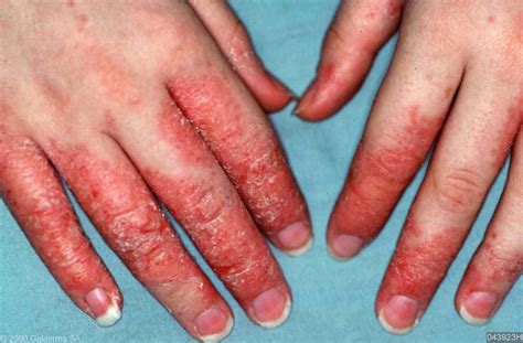 5 Remédios Caseiros Para Tratar Eczema Dicas De Saúde