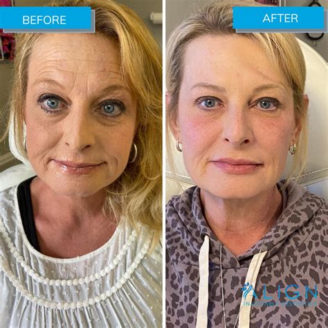 Before And After Dysport For Wrinkles Align Injectable Aesthetics
