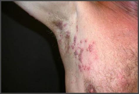 Pictures Of Shingles Under The Armpit Shingles Expert