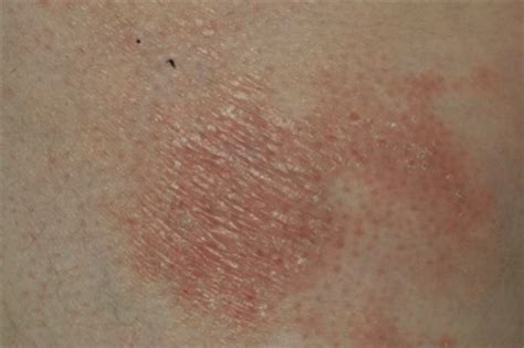 Mycosis Fungoides Patch Erythematous Atrophic And S Open I