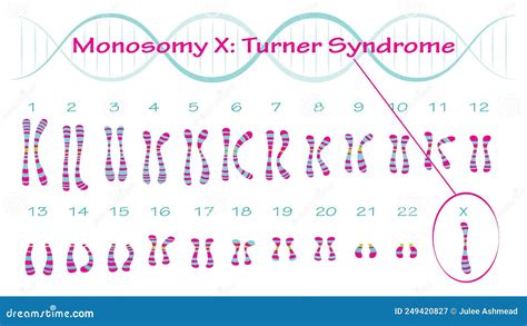 Monosomía X Cariotipo Del Síndrome De Turner Ilustración del Vector