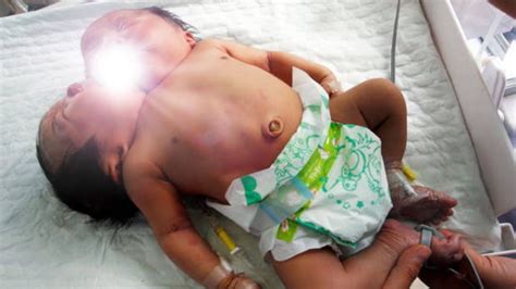 this woman gives birth to ‘rare conjoined twins with two heads three arms and shared organs